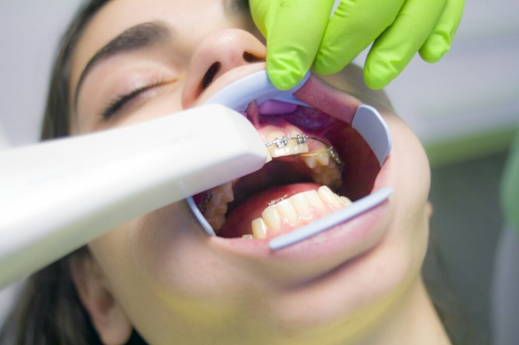 Patient having whitening trays fitted during teeth whitening in Dubai